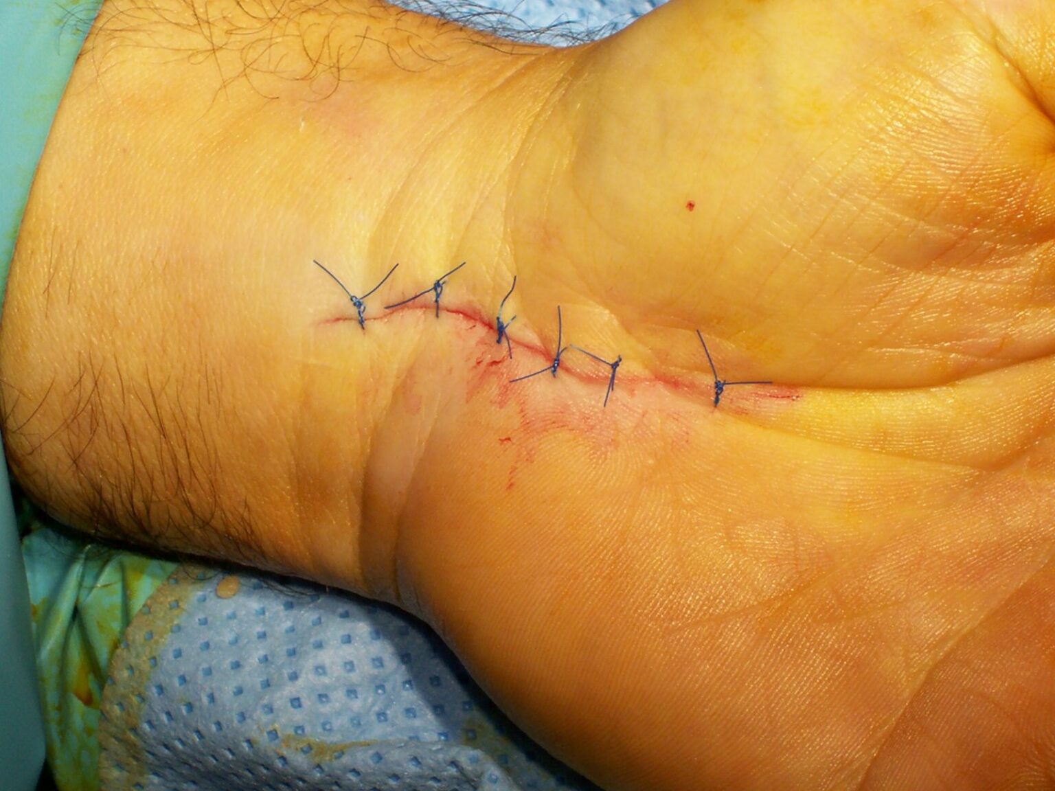 What You Need to Know About Carpal Tunnel Surgery NZ for Long-Term Wrist Relief